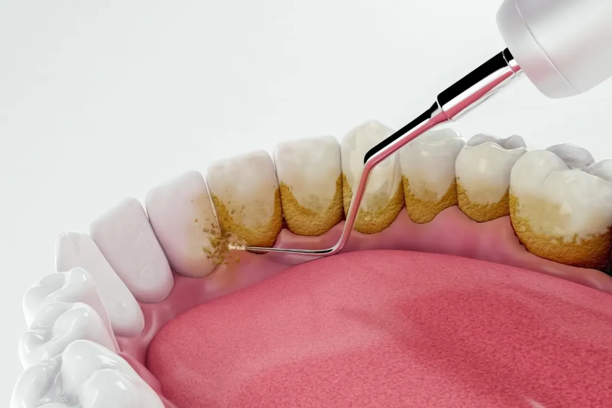 Scaling (Tartar Removal)