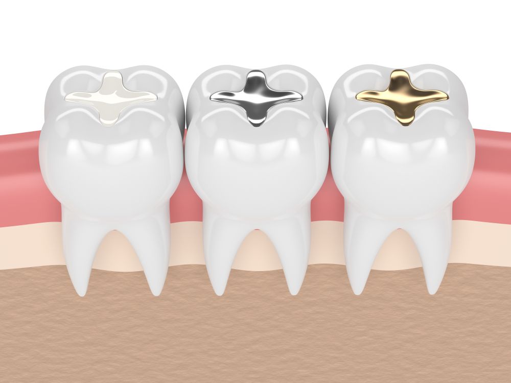 Dental Filling