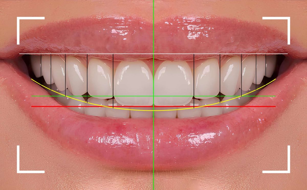 Smile Design